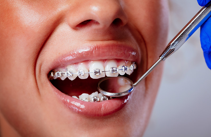 Rovnátka v Bratislave Sapphire Dental Clinic
