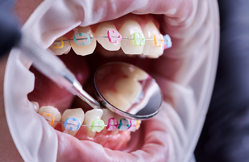 Farebné traky v Bratislave Sapphire Dental Clinic