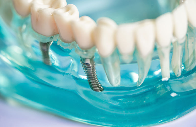 Implantácia Sapphire Dental Clinic Bratislava